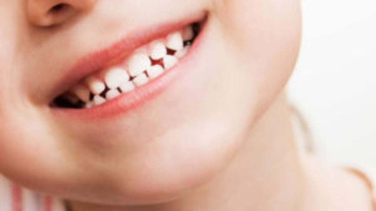 cavities in children baby teeth