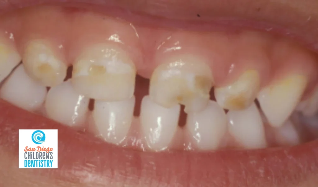 Early Signs of Cavities in Kids' Teeth