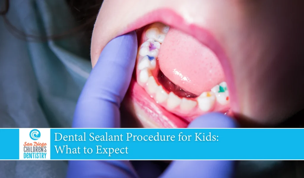 Dental Sealant Procedure for Kids What to Expect
