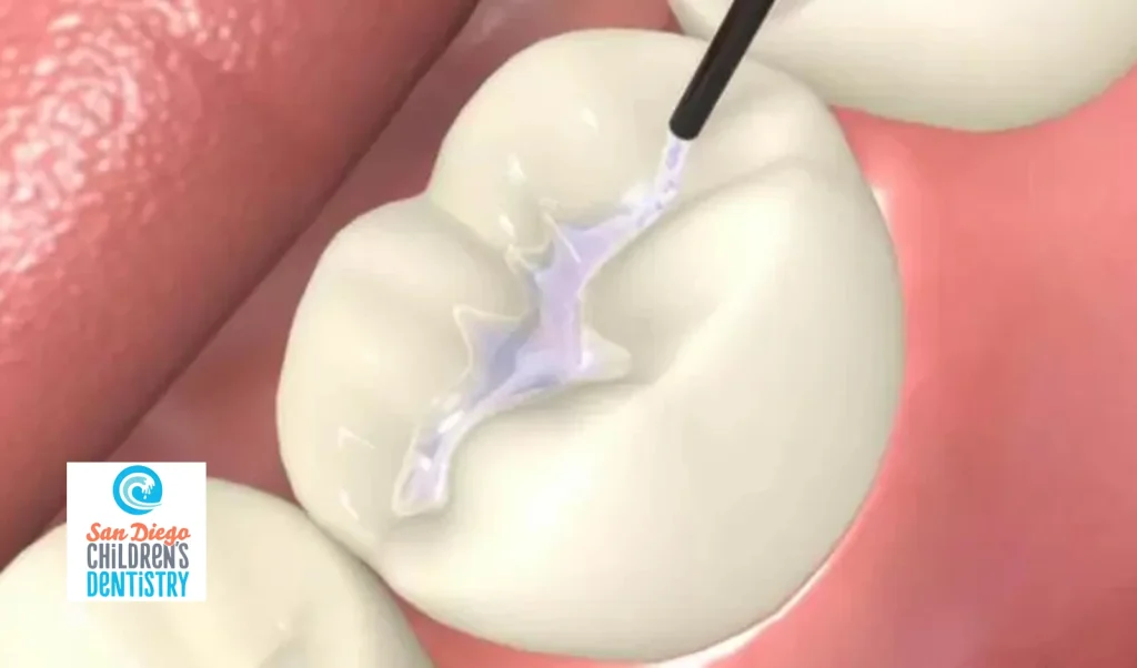 What Are Dental Sealants